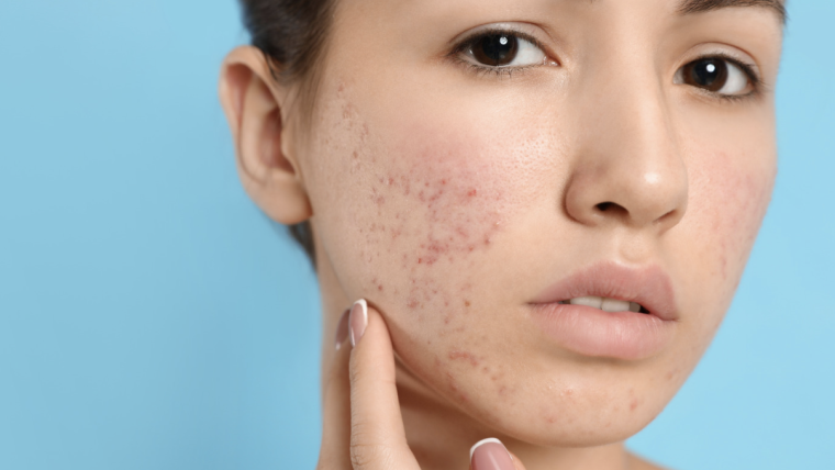 High-Demand Acne Treatment Appointment in Arlington, Virginia
